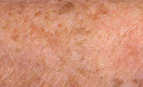 Macchie della pelle: scrub e peeling enzimatico per favorire il ricambio cellulare.